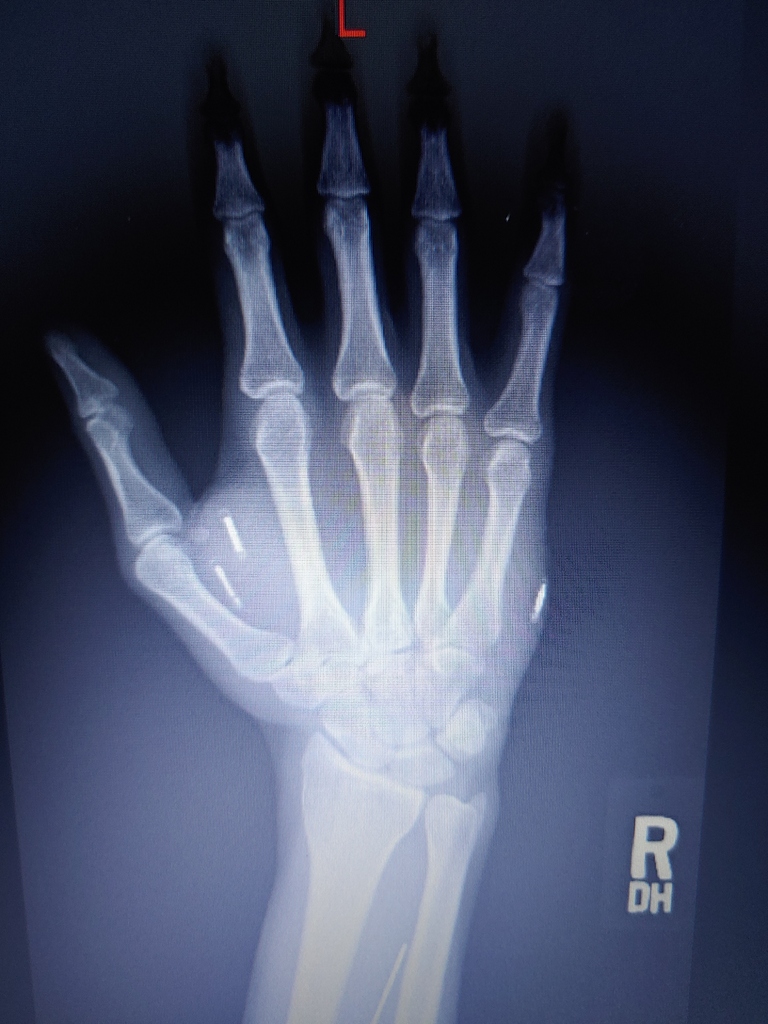 Post x-rays here! - Things I want to save - Dangerous Things Forum