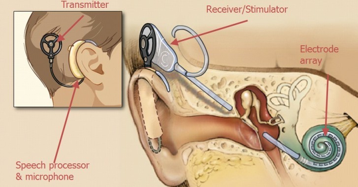 cochlear-implant